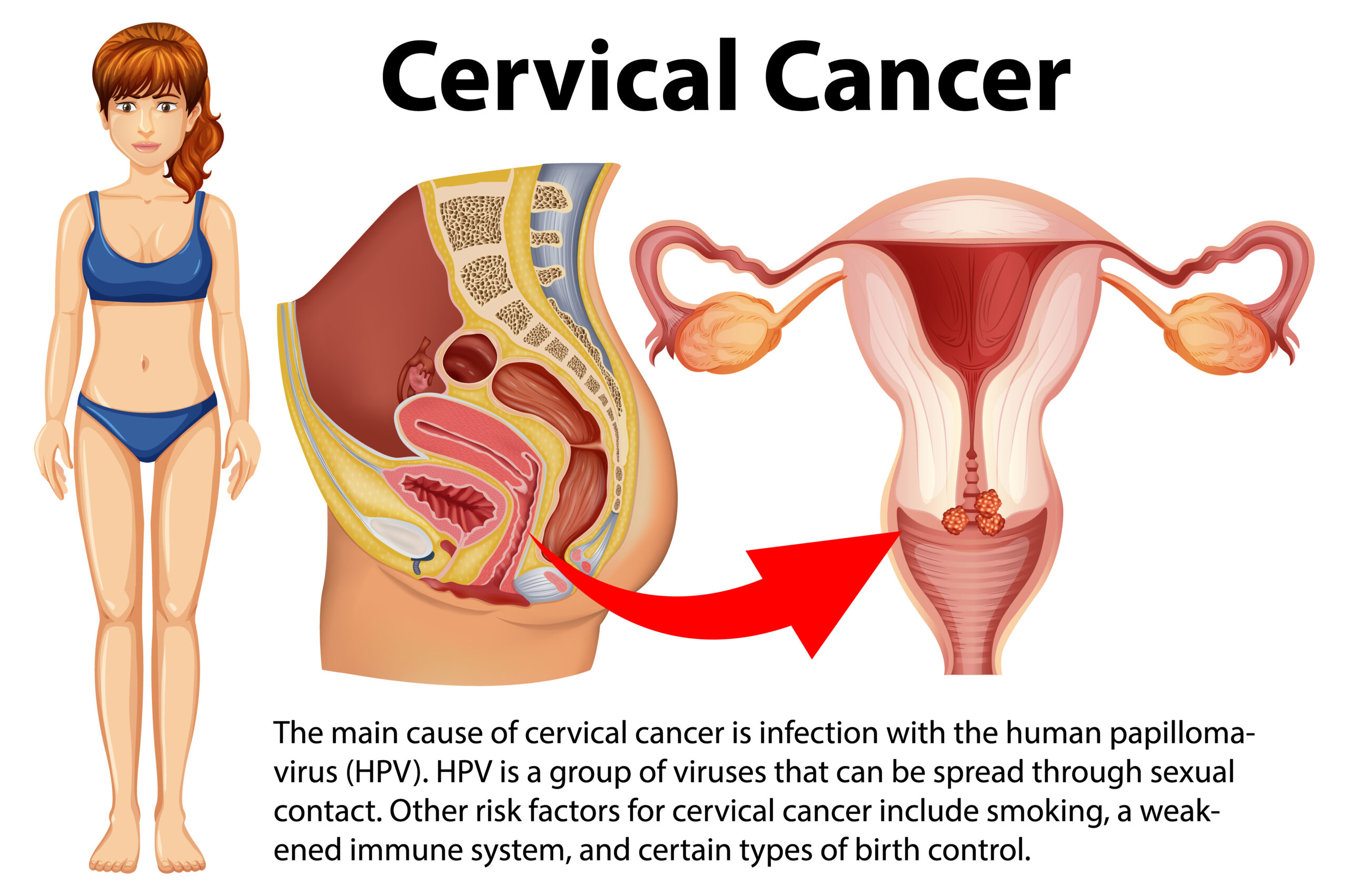 Cervical Cancer